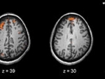 Schizophrenia originates early in pregnancy, â€œmini-brainâ€, research suggests