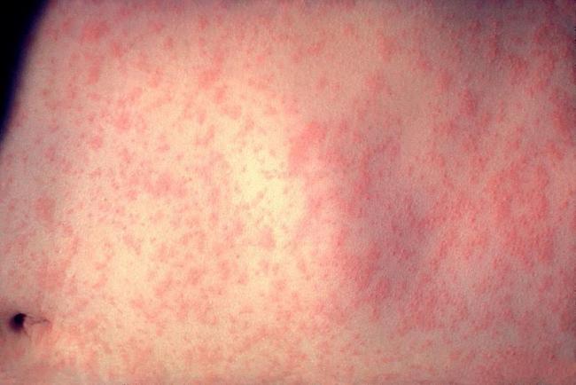 Measles outbreaks in Canada