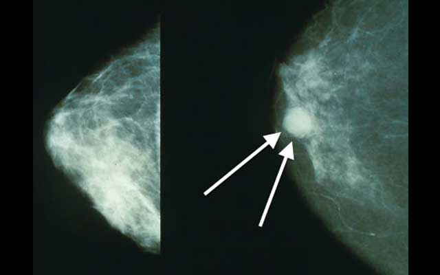Breast cancer treatments may increase the risk of heart disease