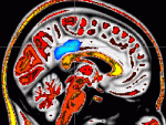 'Mindful people' feel less pain; MRI imaging pinpoints supporting brain activity