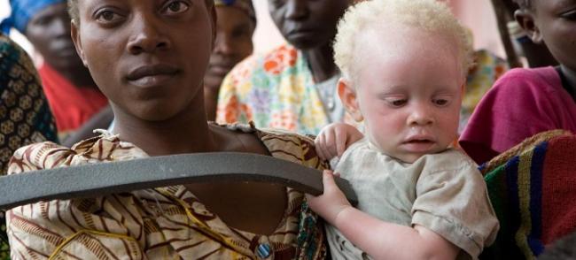Albinism: UN official welcomes latest developments in â€˜landmarkâ€™ Malawi murder case