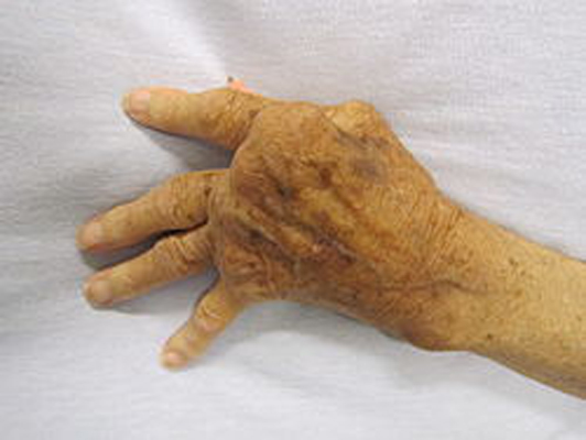Scorpion venom component may treat rheumatoid arthritis:Study