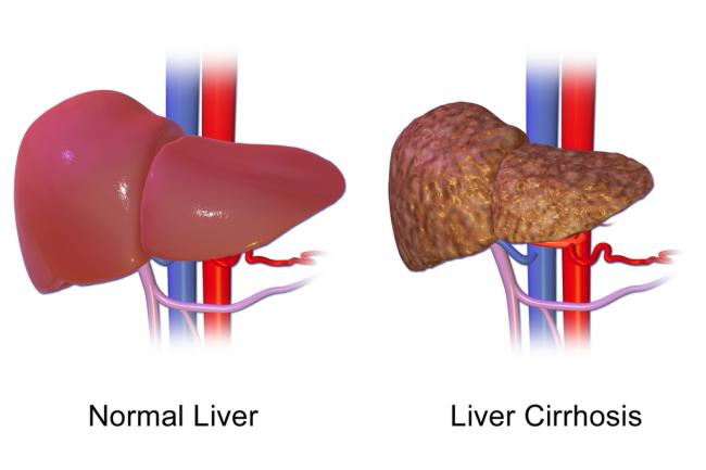 Gut microbes could help clinicians better predict the risk of hospitalization for patients with cirrhosis