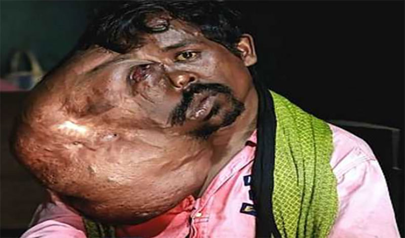 Bengaluru doctors remove 8kg plus tumor from Odisha man's face