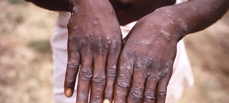 Monkeypox: UNAIDS ‘concerned’ about stigmatizing language against LGTBI people