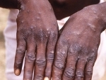 Monkeypox: UNAIDS ‘concerned’ about stigmatizing language against LGTBI people