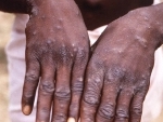UAE reports first case of Monkeypox