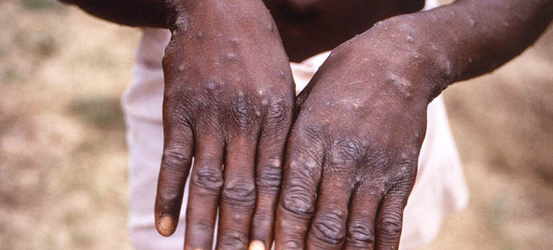 UAE reports first case of Monkeypox