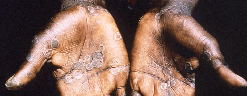 Monkeypox: How it spreads, who’s at risk - here’s what you need to know