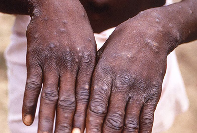 WHO upgrades global monkeypox threat to 'moderate'