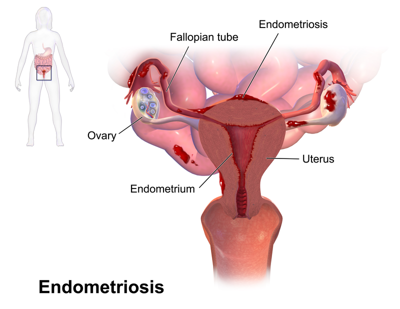 Endometriosis Foundation of India flags lack of specialists in the field in India