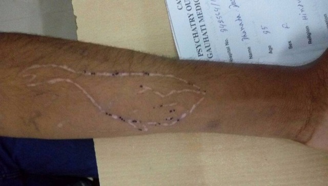 Blue Whale hits Assam : Minor boy admitted in hospital 