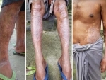 Skin disease epidemic breaks out in Meghalayaâ€™s Garo Hills