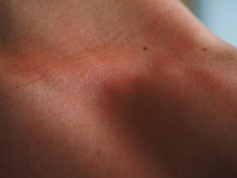 Kasaragod: Child suffer sunburn, admitted to hospital