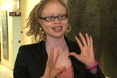 â€˜Witchcraftâ€™ beliefs trigger attacks against people with albinism, UN expert warns   