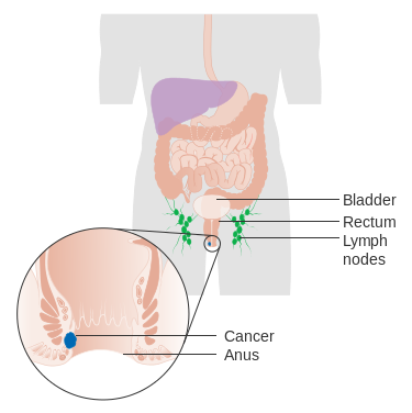 Anal cancer rising worldwide, says study