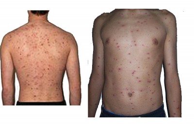 Chicken pox strikes seven Bihar districts, vaccine not available in govt hospitals