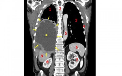 Cancer cells destroyed with dinosaur extinction metal, finds study 