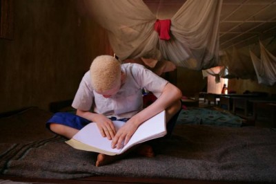 Joint African action crucial to protect persons with albinism from violence, highlights UN expert
