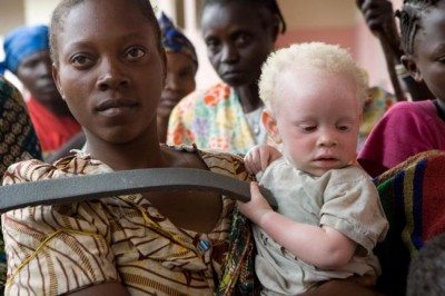 UN expert urges greater protection of people with albinism from witch doctors