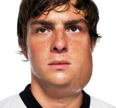 Canada, U.S. concern with reappearance of Mumps