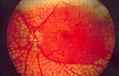 Liverpool to lead international diabetic eye disease research project: Study