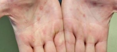 India reported eight monkeypox cases so far: Health Minister