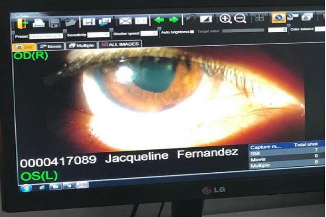 Jacqueline Fernandez suffers from permanent eye injury 