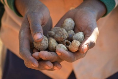 Address double burden of malnutrition: WHO