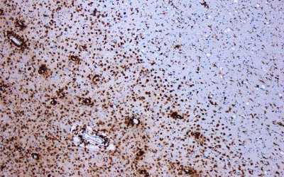 Questionnaires can be a good predictor of survival rates in multiple sclerosis, says study