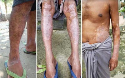Skin disease epidemic breaks out in Meghalayaâ€™s Garo Hills