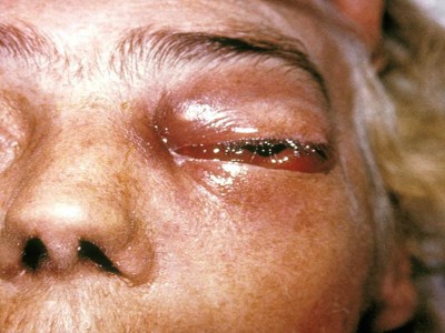 Two cases of black fungus detected in Bangladesh