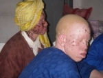 UN urges protection for Albinos after Tanzania killing