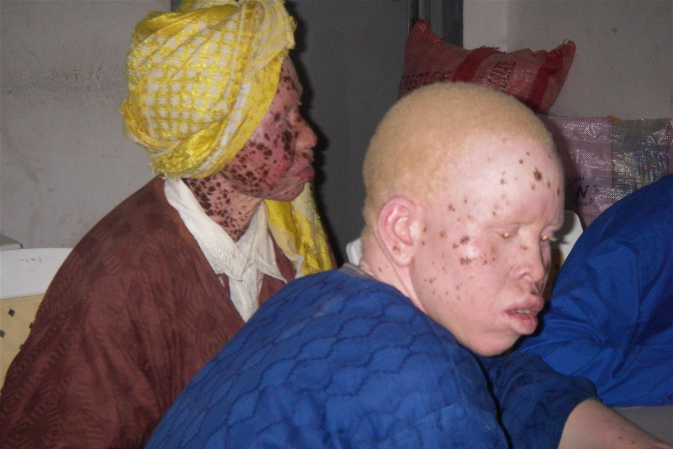 UN urges protection for Albinos after Tanzania killing