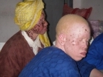 Malawi leader condemns attacks on people with albinism: UN
