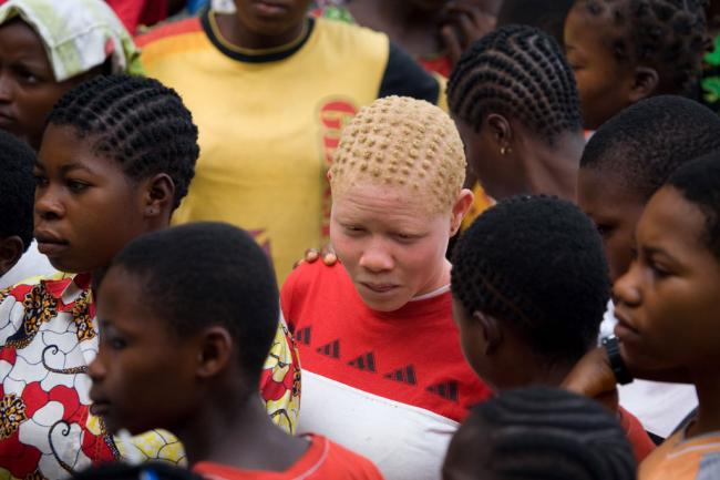 UN rights experts appeal to stop attacks against persons with albinism