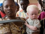  On Albinism Awareness Day, Ban urges all countries to break cycle of attacks and discrimination