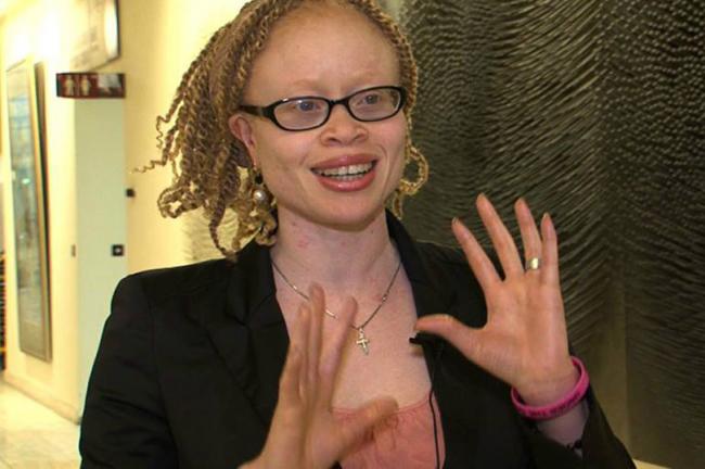 â€˜Witchcraftâ€™ beliefs trigger attacks against people with albinism, UN expert warns 