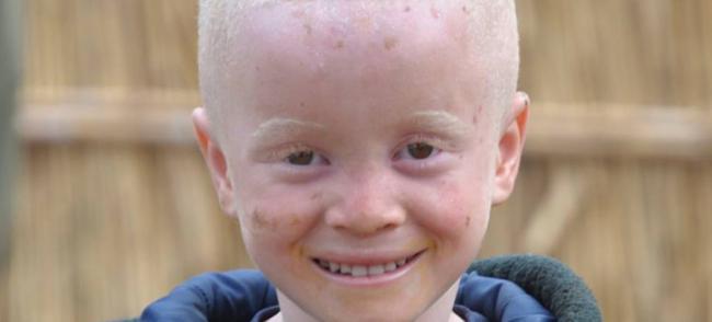 Kenya makes progress in supporting people with albinism, but â€˜much remains to be doneâ€™ says UN expert