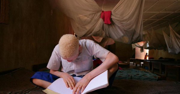 â€˜Much moreâ€™ can be done to raise awareness about the plight of persons with albinism: UN chief