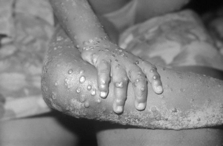 Indonesia on alert as monkeypox case confirmed in neighboring Singapore