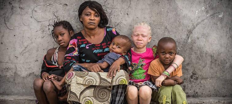 Making education safe for children with albinism in Malawi